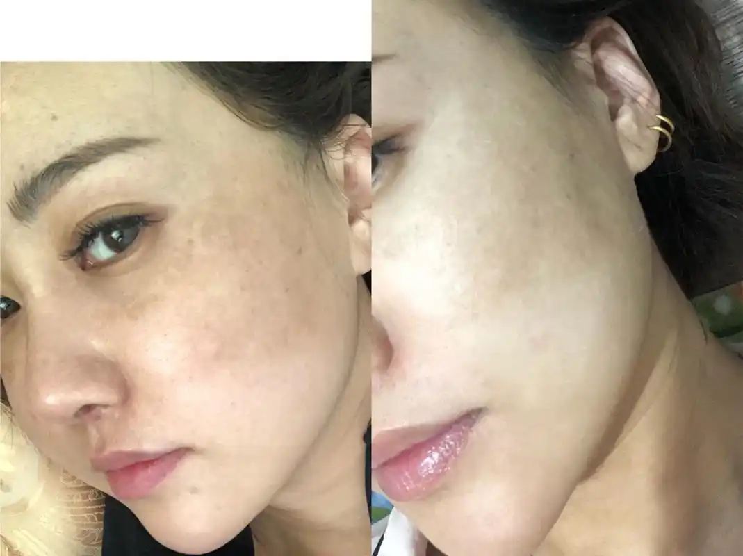 氨甲环酸治疗黄褐斑十一天 做皮秒激发出了大片黄褐斑 氨甲环酸内服