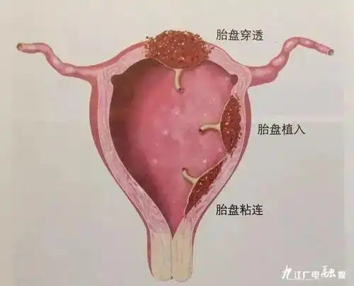 九江市妇幼保院海扶专科成功治愈多位胎盘植入患者