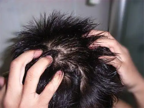 为什么头皮会疼头皮刺痛如针扎一样一阵一阵的痛