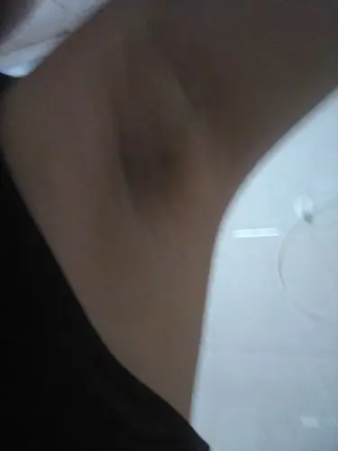 腋下出现了这种情况 不捏不疼 一捏有一种针扎似的疼痛感 是不是什么