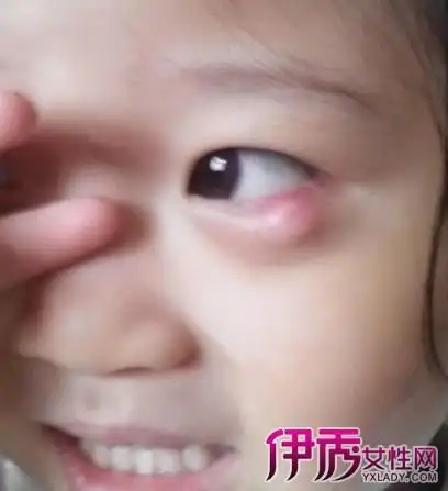 【图】麦粒肿化脓怎么办 专家推荐5个方法根治病痛