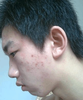 治疗青春痘的好方法,小偏方_word文档在线阅读与下载_无忧文档