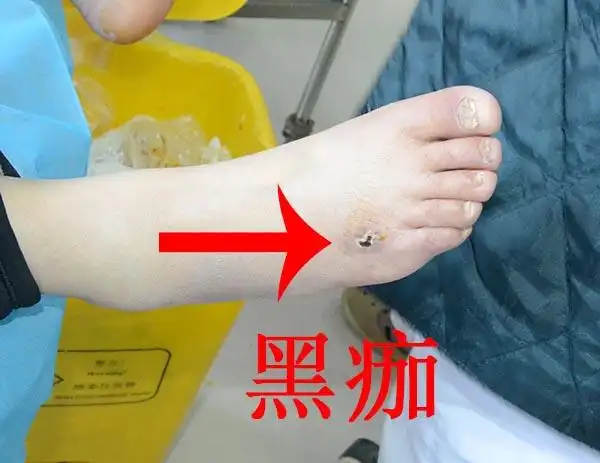 有图有真像糖尿病足早期症状一旦发现要及早治疗