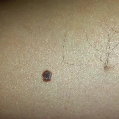 良性黑色素痣图片