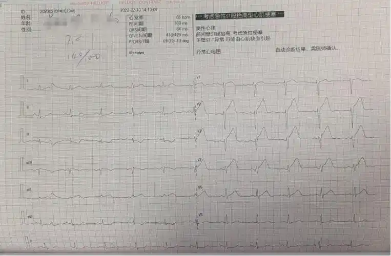 活心丸(浓缩丸)治疗病例之70- 急性心肌梗死介入术后女性患者|心肌
