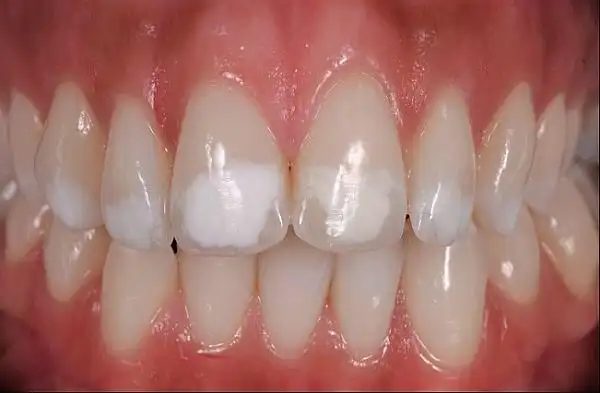 icon牙釉质白垩斑树脂渗透疗法学习班--泉州站-在线订票-互动吧