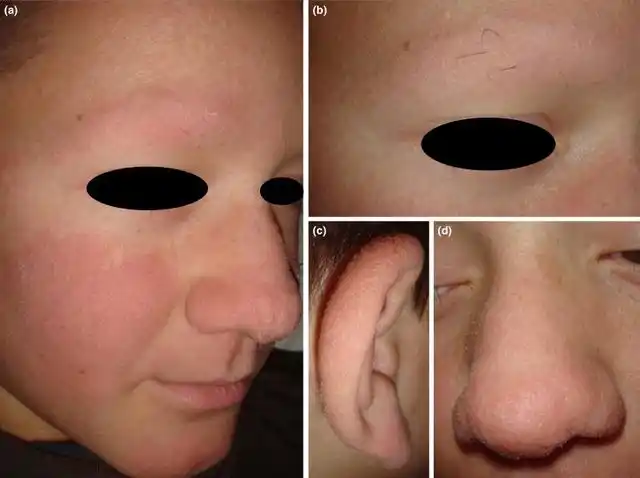 棘状毛发发育不良:从一个病例说开去