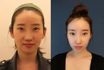 缪慈整形医院微整形瘦脸对比图