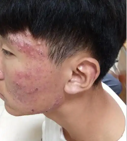 在青春期,不要总是次油腻,油炸的热气食物,这样会导致青春痘迅速生长