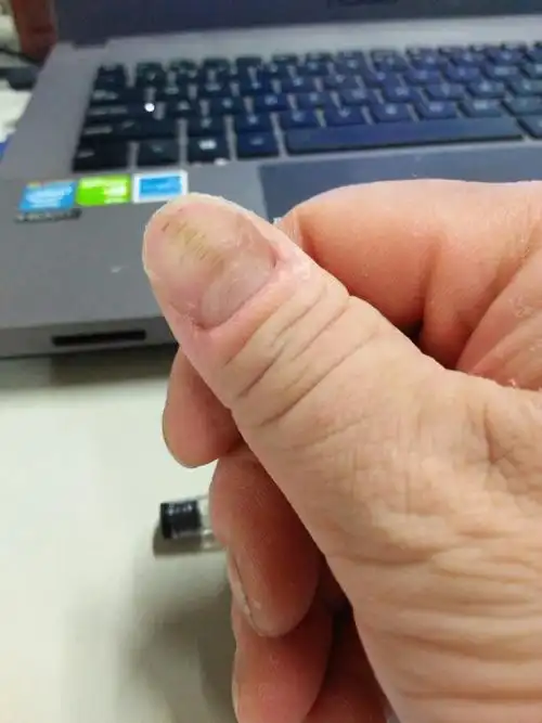 我的大拇指指甲上都是凹纹是怎么怎么回事?_百度知道