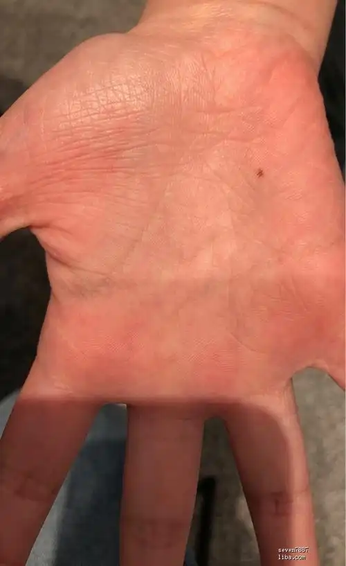 手掌痣不清(手掌心黑痣不痛不痒很多年)