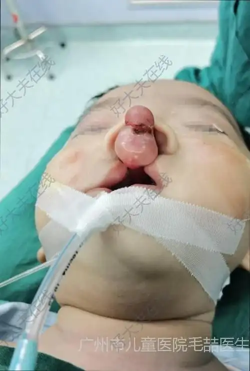 双侧唇裂_唇腭裂 - 好大夫在线