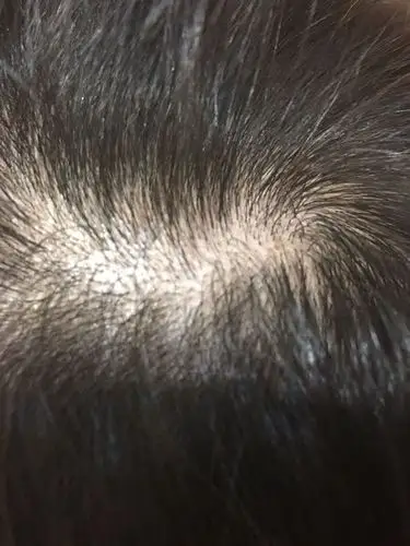 头皮毛囊堵塞怎么办