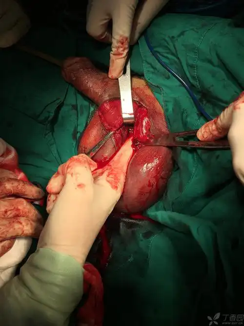 一例少见的阴茎海绵体断裂