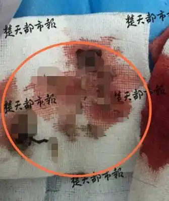 男子后脑勺长50条蛆虫!只因他长"包"后做了这个动作