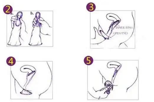 女用避孕套的使用方法