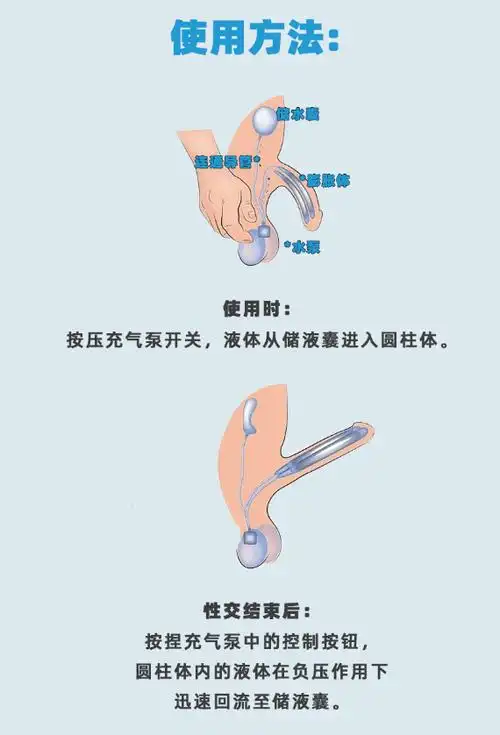 这种手术术后阴茎外观与常人无异,可射精和生育等优点,目前,该手术