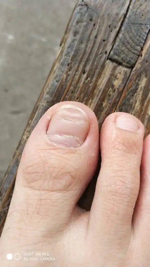 脚指甲有横纹