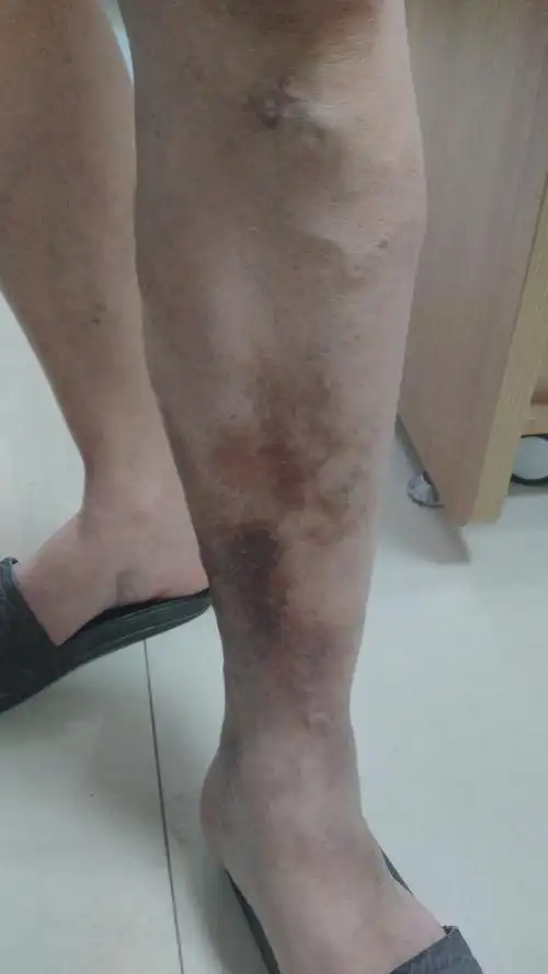 治疗的静脉性溃疡反复发作,常见于踝关节附近及小腿下段,俗称"老烂腿