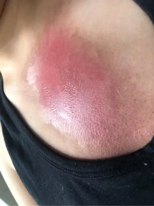 22结束化疗6.18结束放疗,什么时候可以养宠物呀