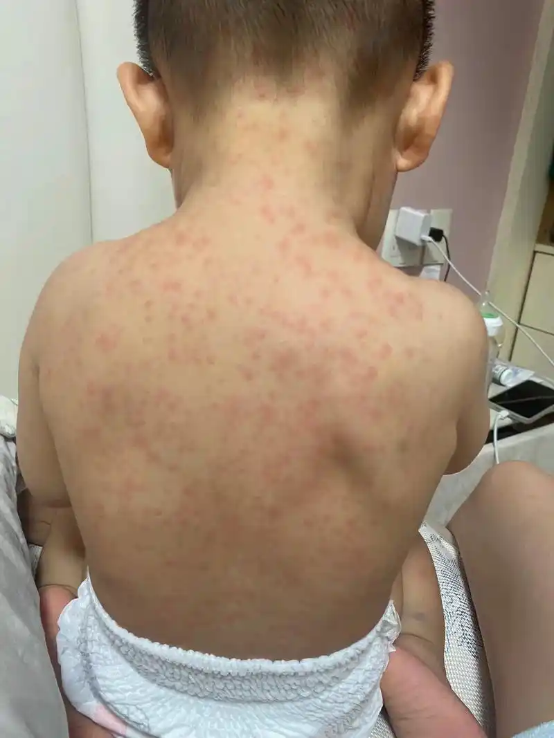 先腹泻后高烧 警惕幼儿急疹.#图文掘金计划 又正常都是每日一 - 抖音