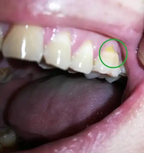 的地方用指甲戳,感觉软软的陷下进去,有酸酸的感觉,好像被腐蚀了一样