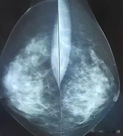 协和牵头制定中国指南发表b超是最适合国人的乳腺癌筛查手段