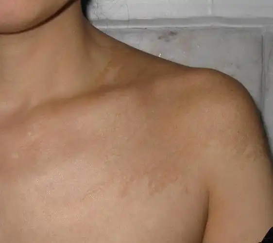 图片分享色素性毛表皮痣