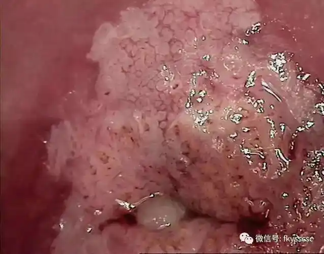 镜下6种异常宫颈图像的解读,值得收藏!