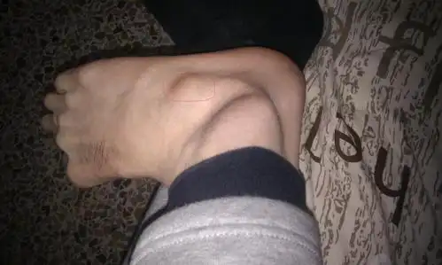 今天穿袜子的时候发现自己的右脚背上有个很突出硬硬的东西,在照片勾