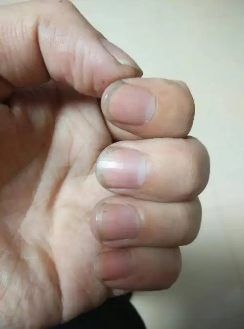 指甲竖纹,怎么回事!