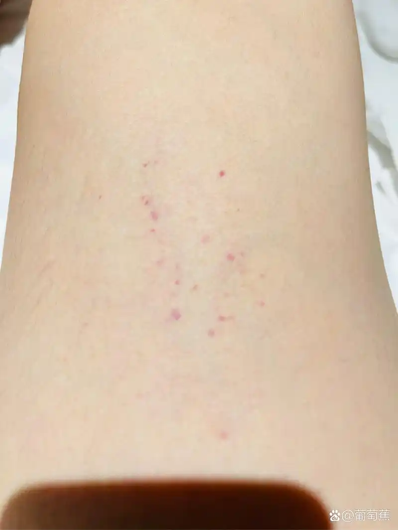 看着腿上的红点,心里有些不安.