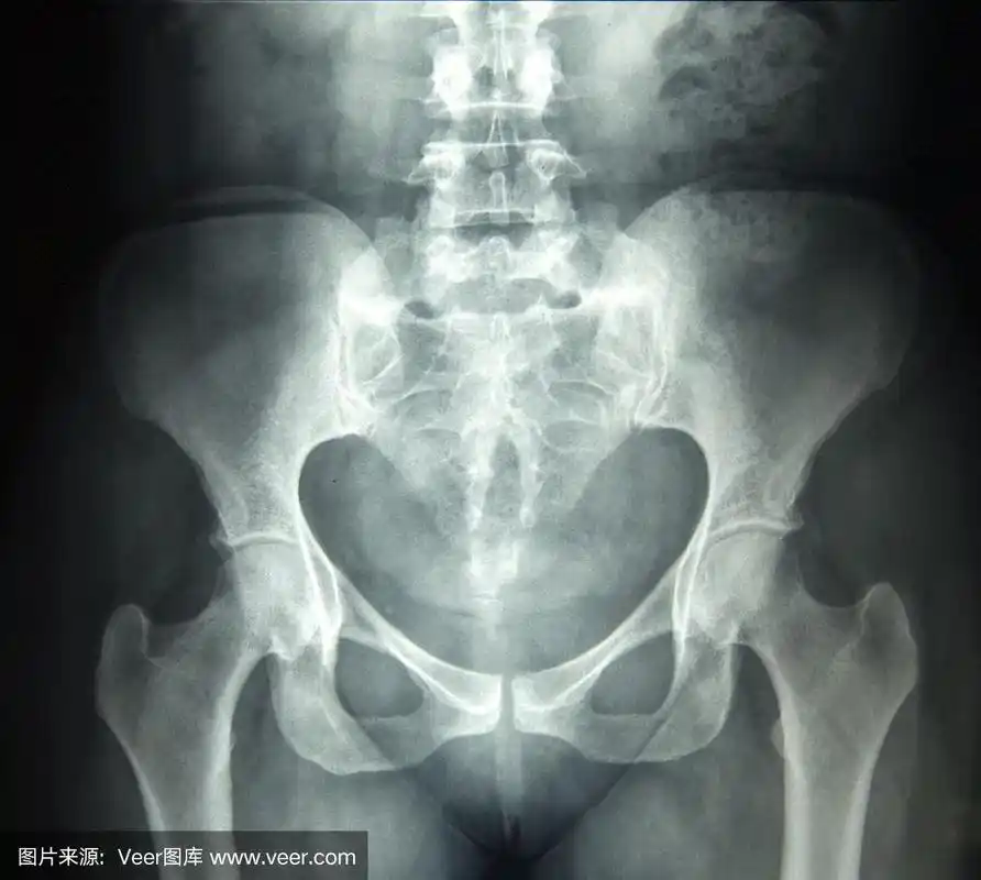 女性骨盆x光片