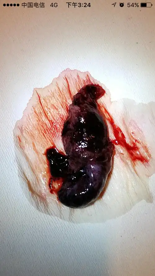 自然流产图片赏析