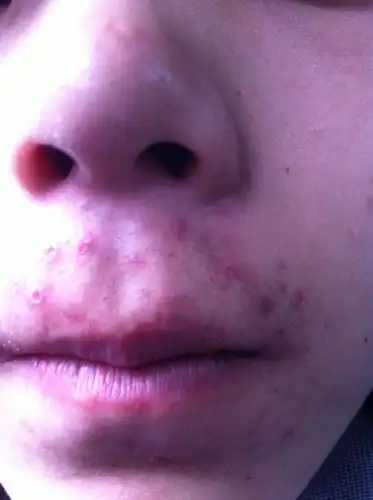 最近几个月老是上火,每次起床嘴巴上就会长出白色的痘痘,然后挤破就会