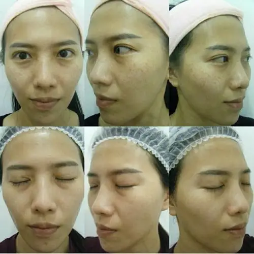 皮秒祛斑韩国真人版洋娃娃坐拥百万粉丝但她卸妆后