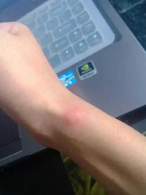 手腕上长了一个包(红色疙瘩),这是怎么回事呢?