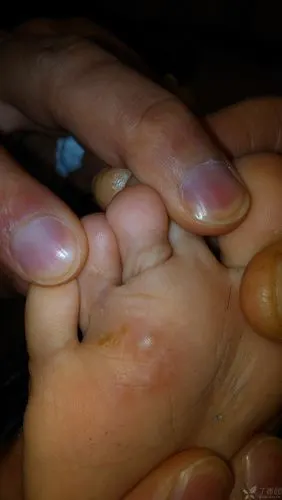 小儿脚底硬茧水泡,请教病因.