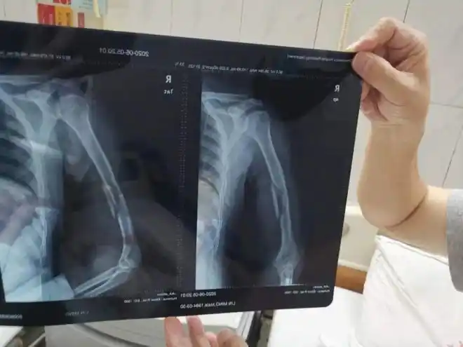 杨医生介绍,经x光检查,吴某某的右肱骨干中段骨皮质不连续,长楔形骨折