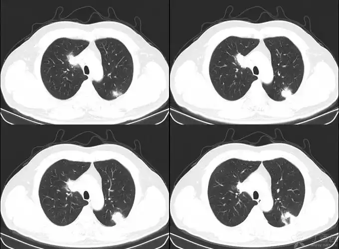 【讨论】双肺多发结节灶85149