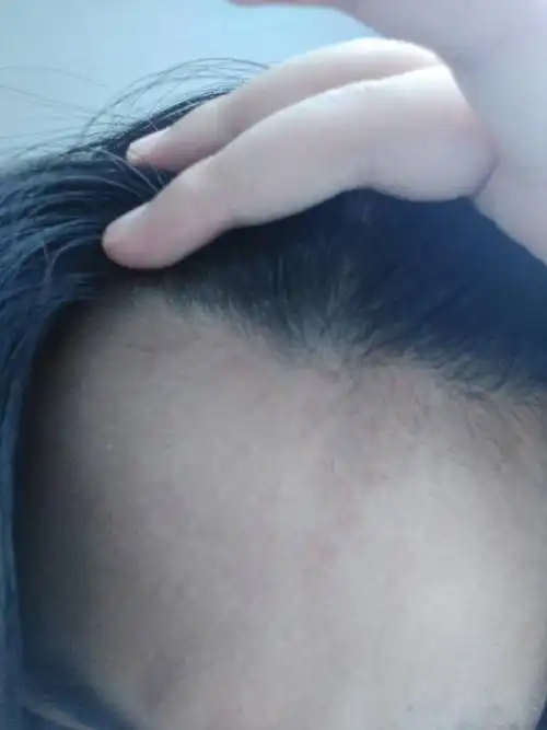 为什么额头这边黑了一块,也不知道从什么时候开始的