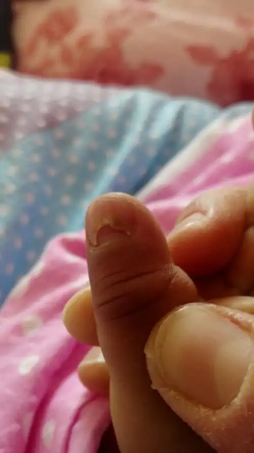 宝宝3岁了手指像脱壳是什么原因