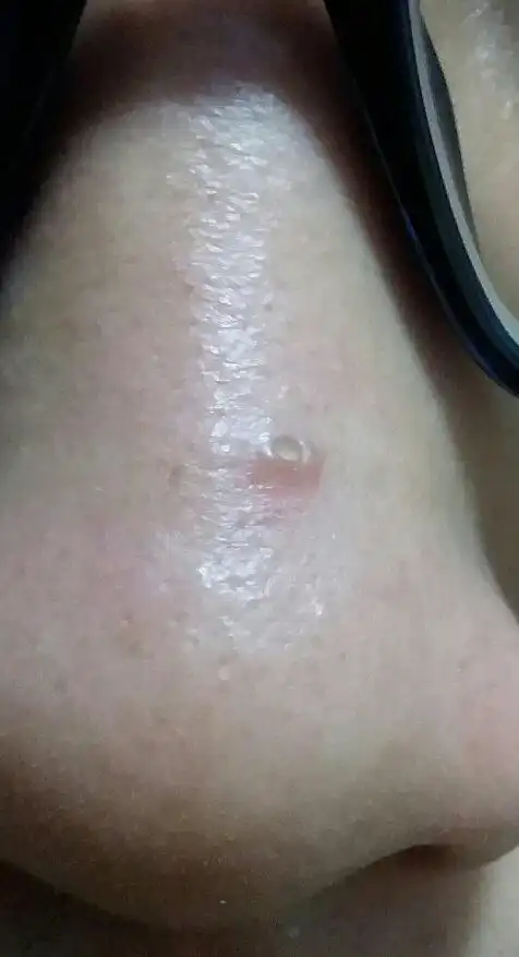 鼻子上这个这算粉刺吗?怎么办?有一个月了 需要挤掉吗?