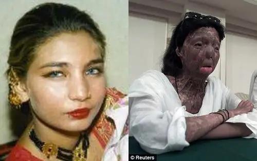 高清:巴基斯坦美艳舞蹈演员被前夫泼硫酸导致面部全毁