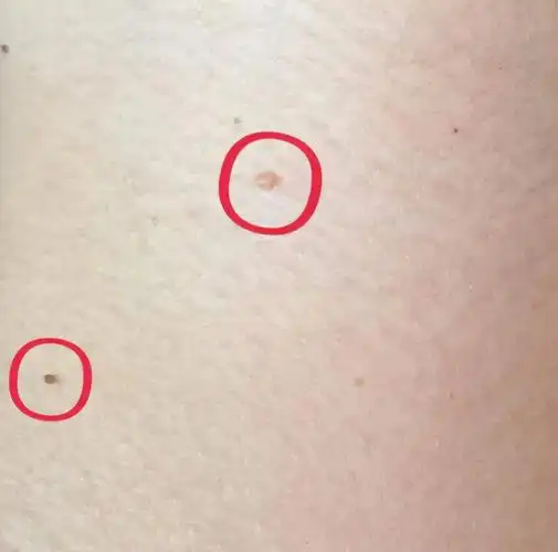 腋下长痘痘是怎么回事不痛不痒(腋下长疣是什么原因)_友友