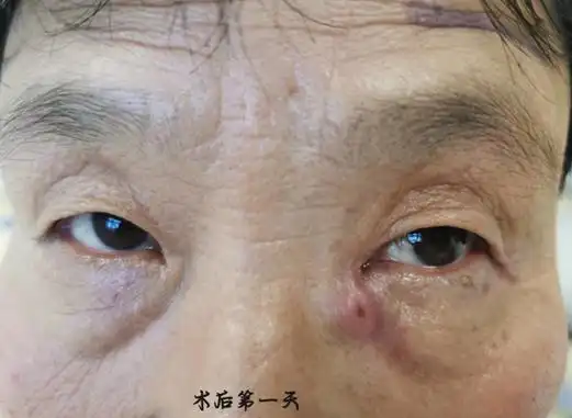 "流泪又流脓",哈尔滨普瑞眼科助你告别慢性泪囊炎_新浪黑龙江_新浪网