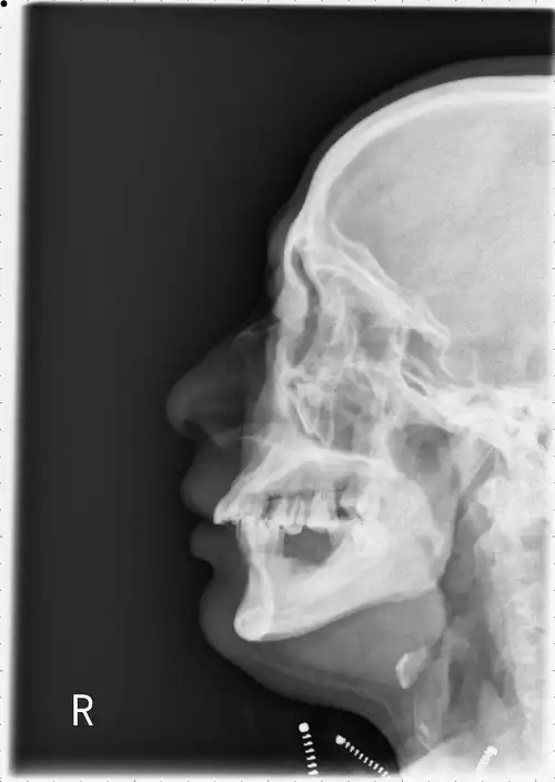 和大家分享一个鼻骨发育异常的