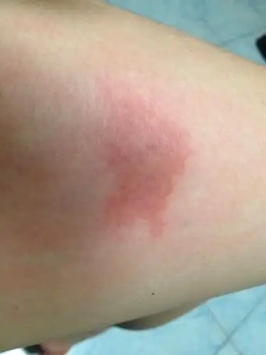 已经四天了,依旧那么红,触摸的话可以感觉到有一大块微凸起,很痒,忍不