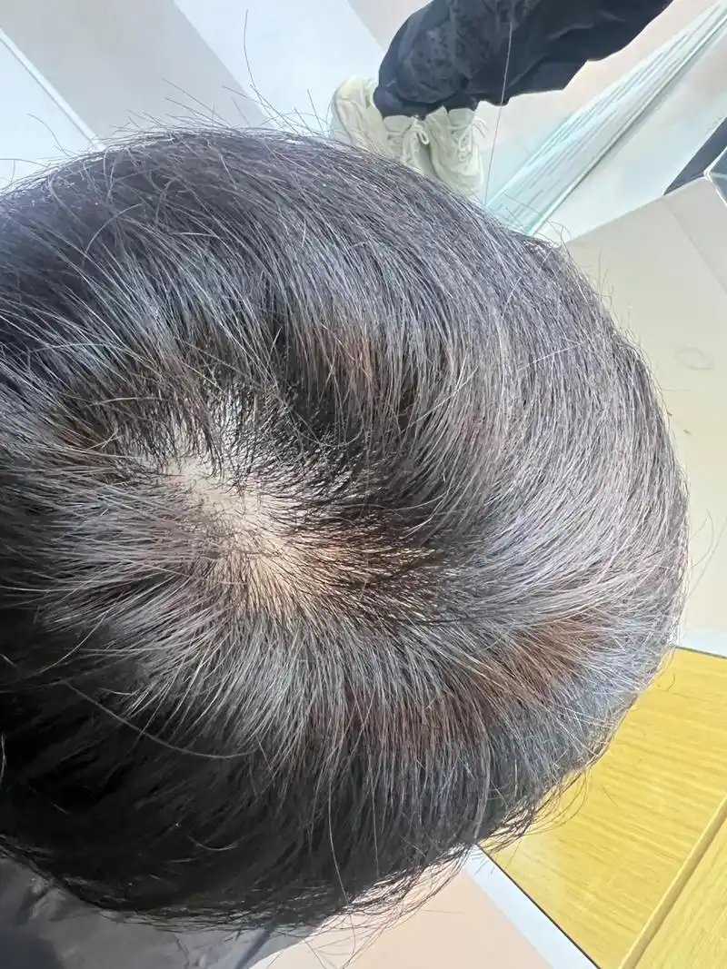 头顶漩涡头发少怎么办?兄弟们这算秃头吗