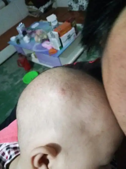 六个月的宝宝头上起了一个大疙瘩,怎么回事啊?看着不算小!